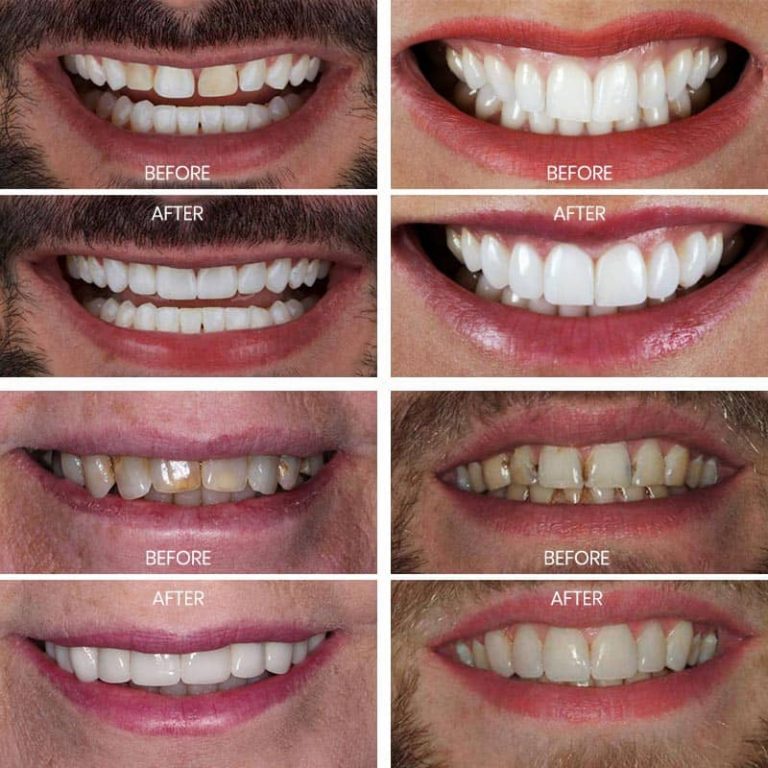 Composite Veneers in Mexico How much are, Materials, Cases, Reviews