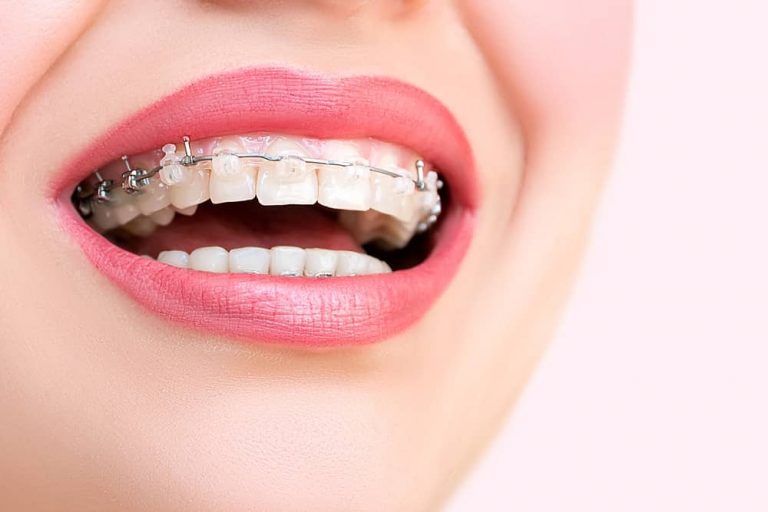How Much do Braces Cost in Mexico? Treatment Guide Dental Mexico
