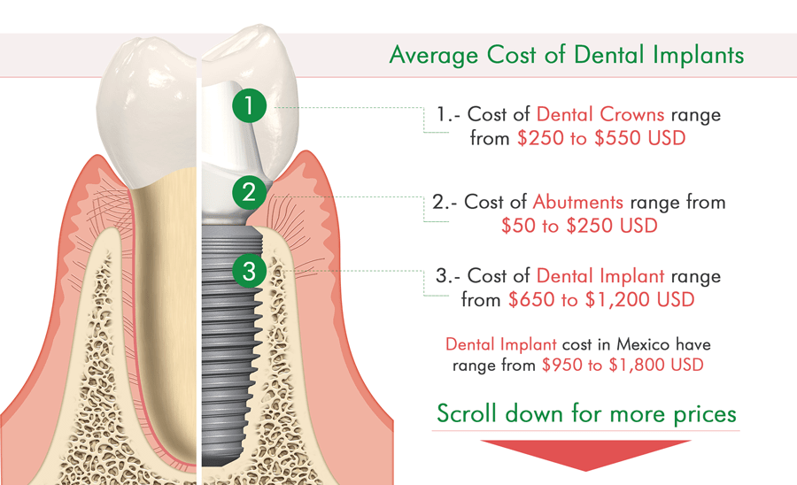 How much are Dental Implants in Mexico? Comprehensive Guide