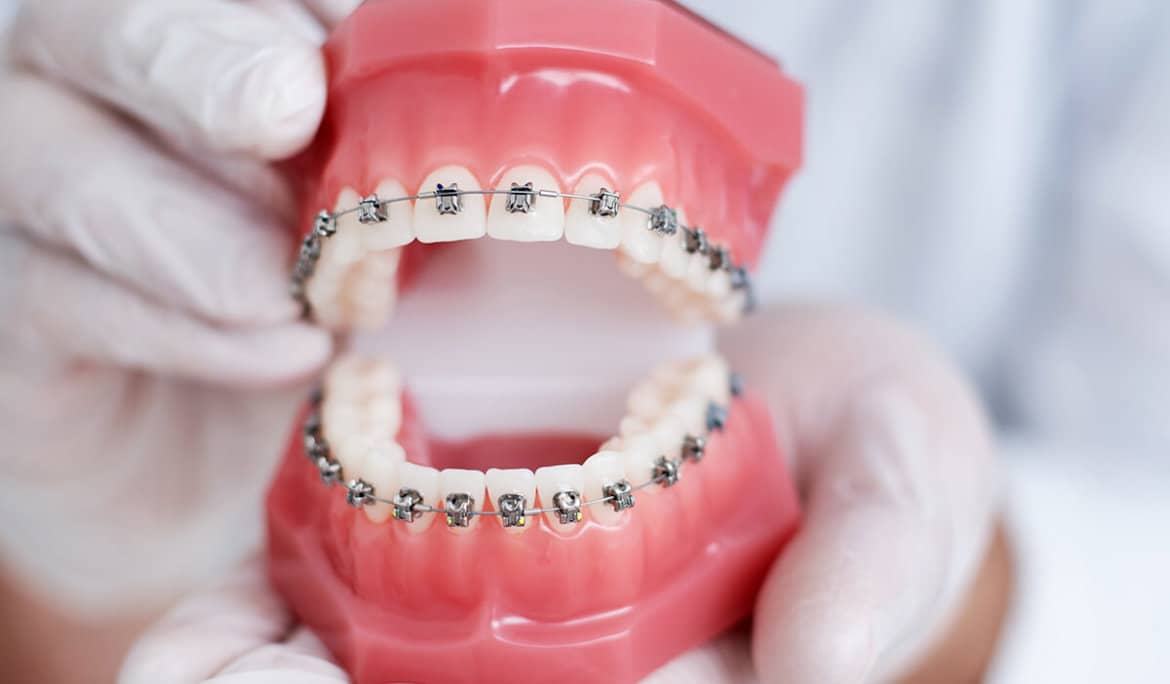 traditional-metal-braces