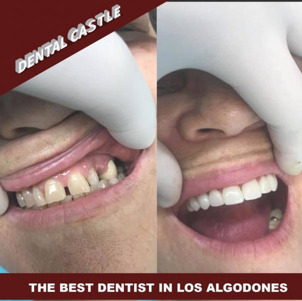 Castle Dental Dental Mexico