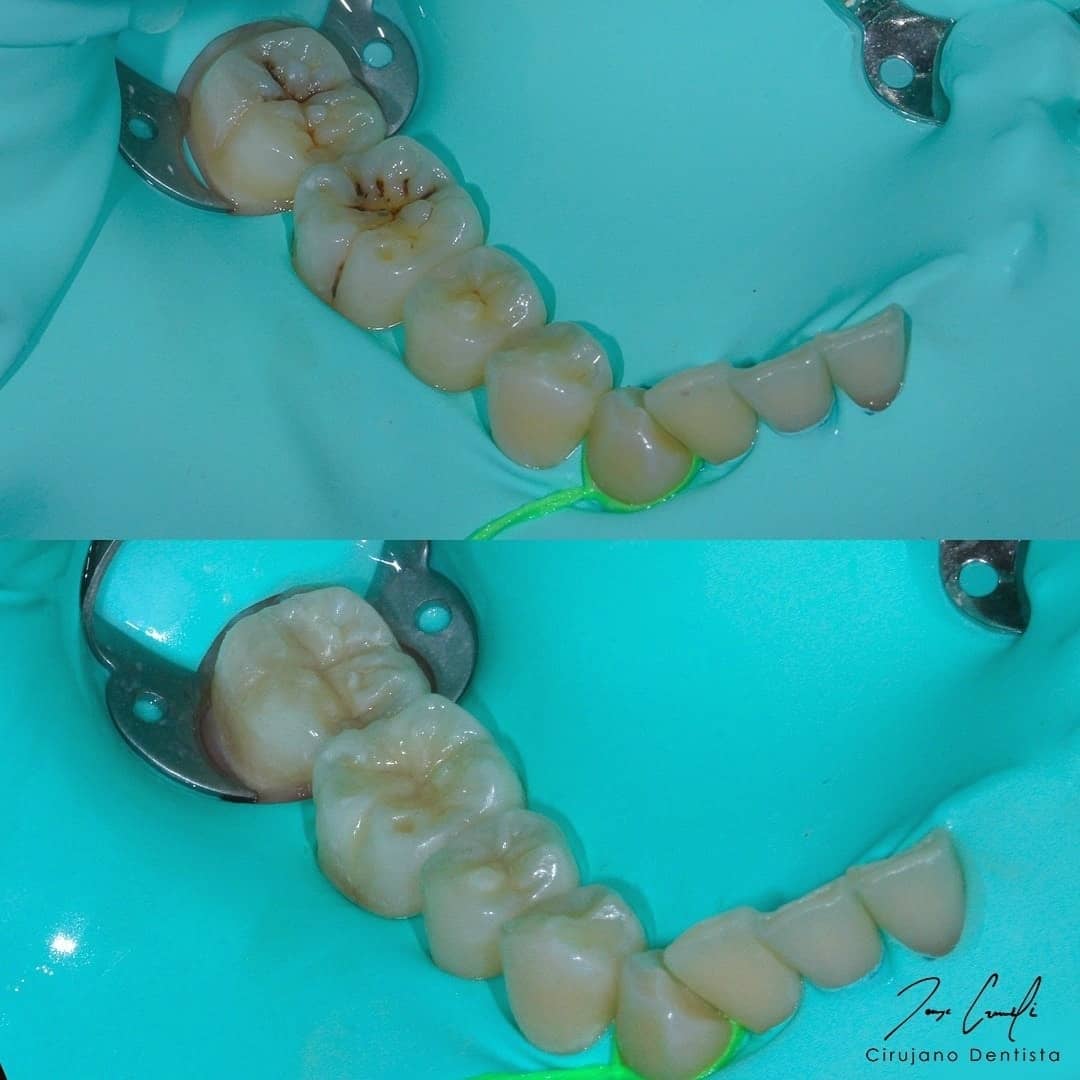 clinica-dental-cuauhtli-before-after-1