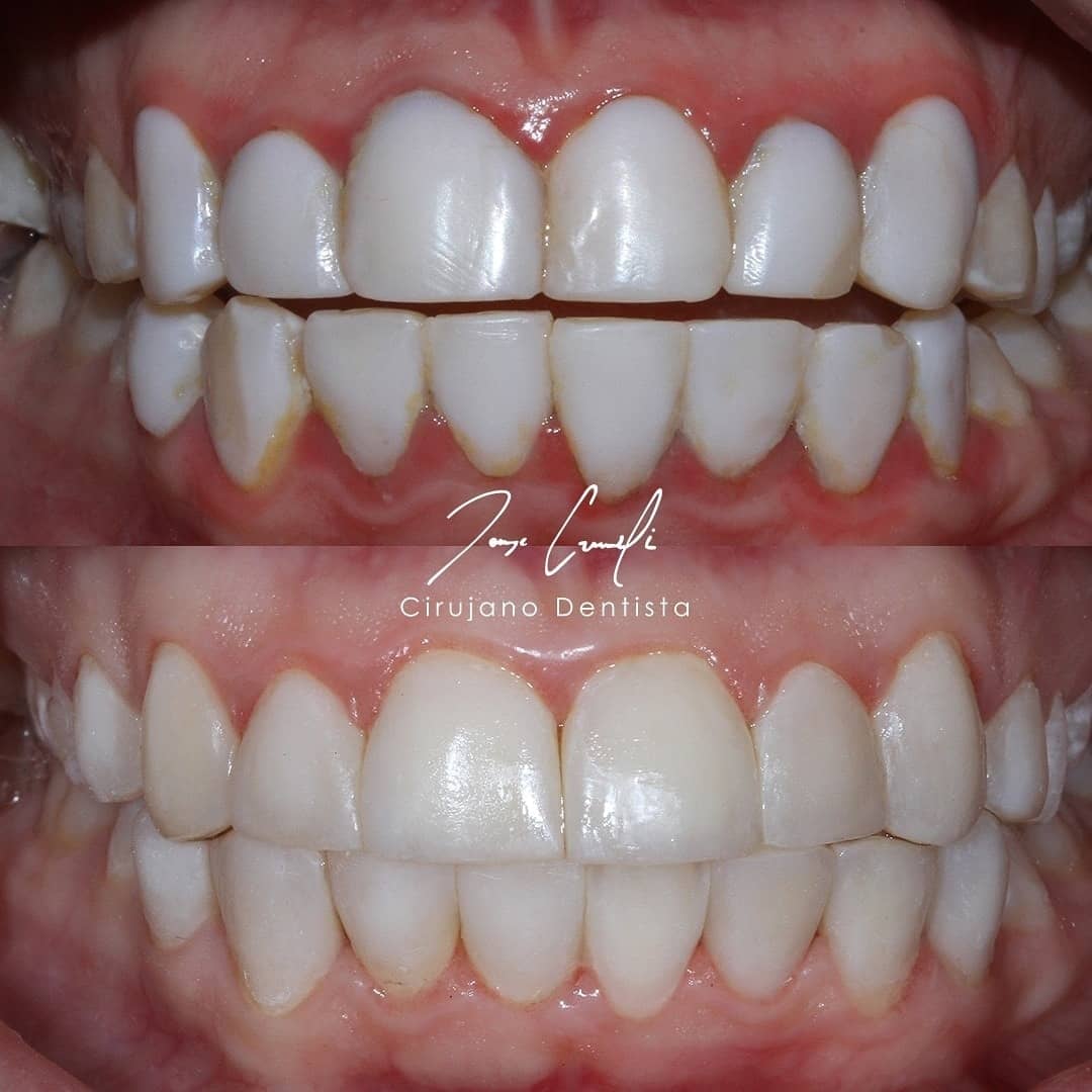 clinica-dental-cuauhtli-before-after-2