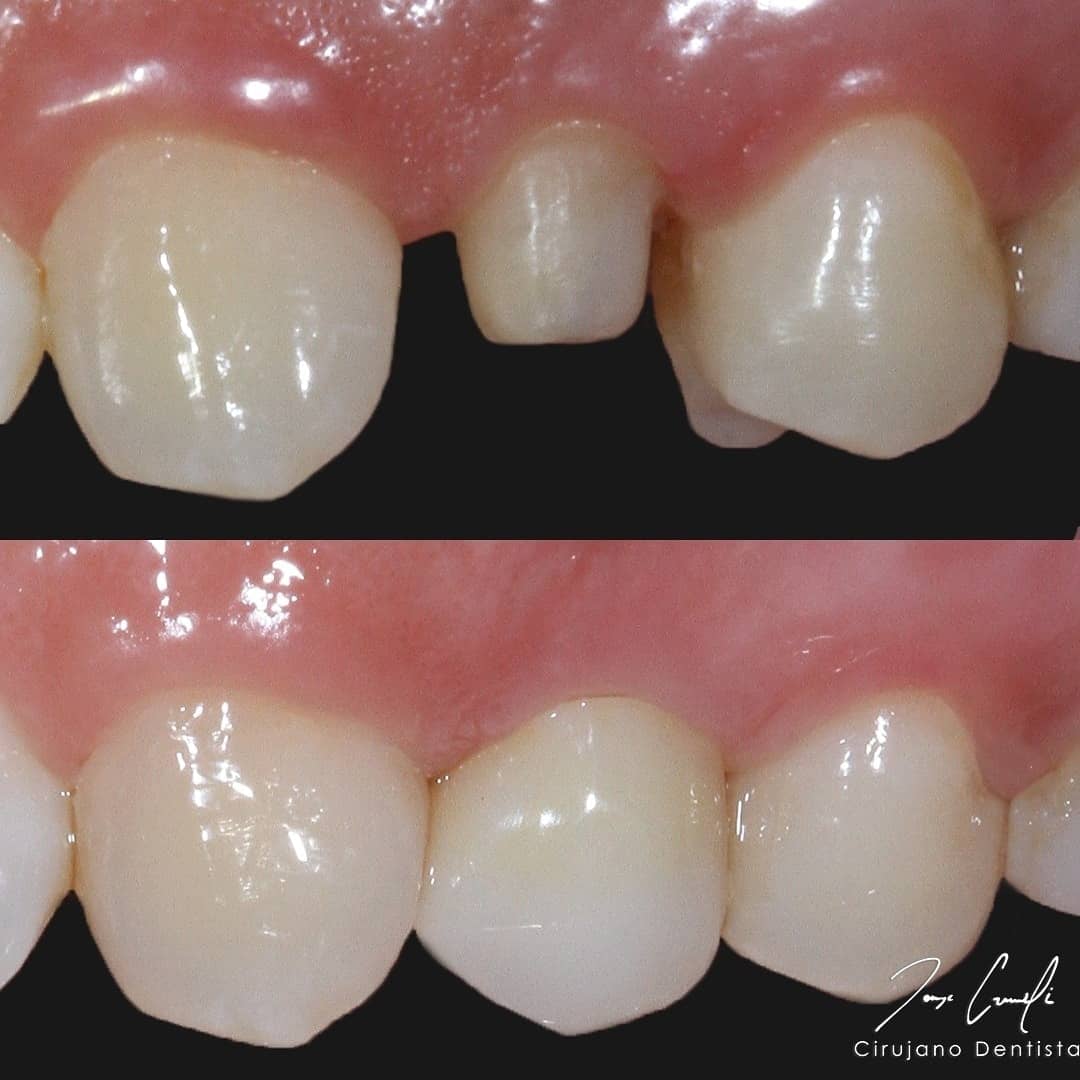 clinica-dental-cuauhtli-before-after-3