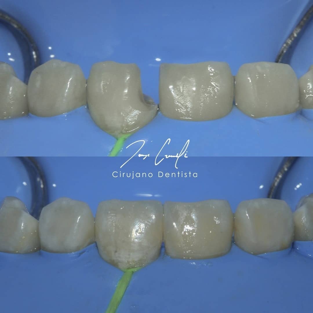 clinica-dental-cuauhtli-before-after