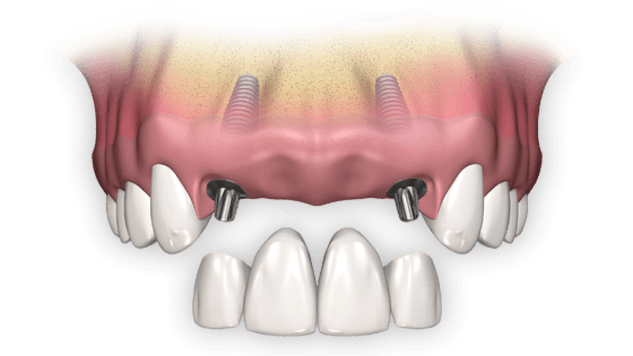 How much does a Dental Bridge cost in Mexico? - Dental Mexico Guide