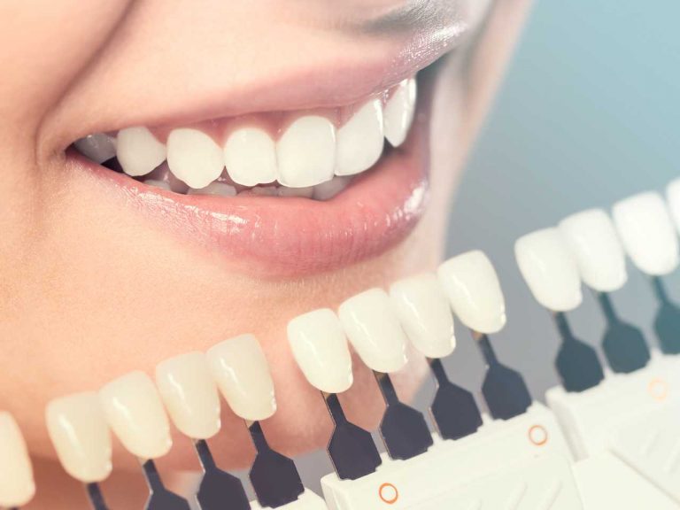 How much do Zirconia Veneers cost in Mexico? Tips, Costs, Reviews
