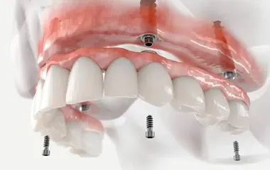 image showing a close-up of dental implants